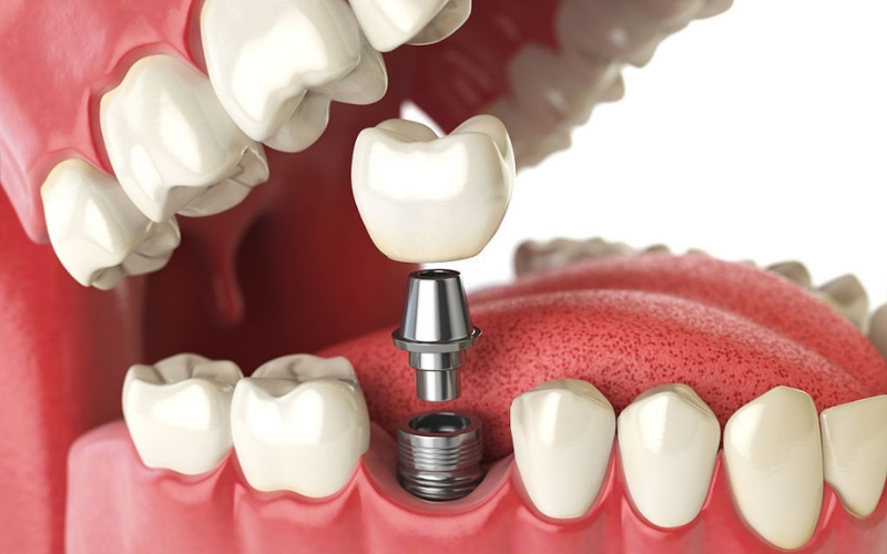 dental-implant-procedure