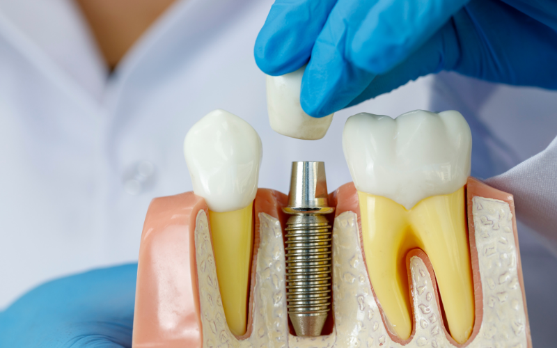 dental-implant